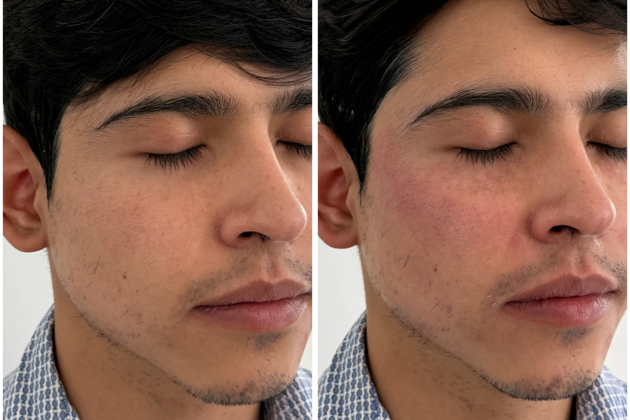 Resultados antes y después de Bioestimulación Masculina en Avoria