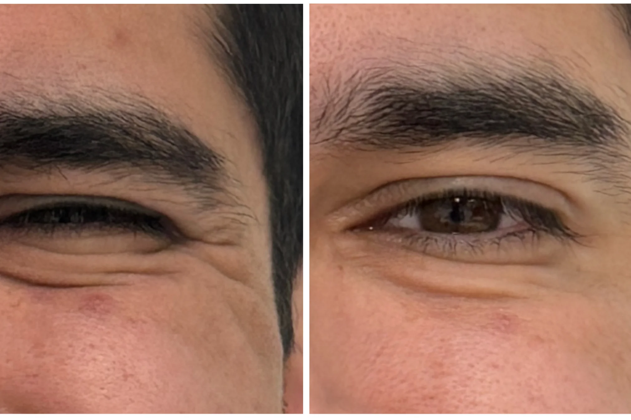 Resultados antes y después de Botox para Hombres (Brotox) en Avoria