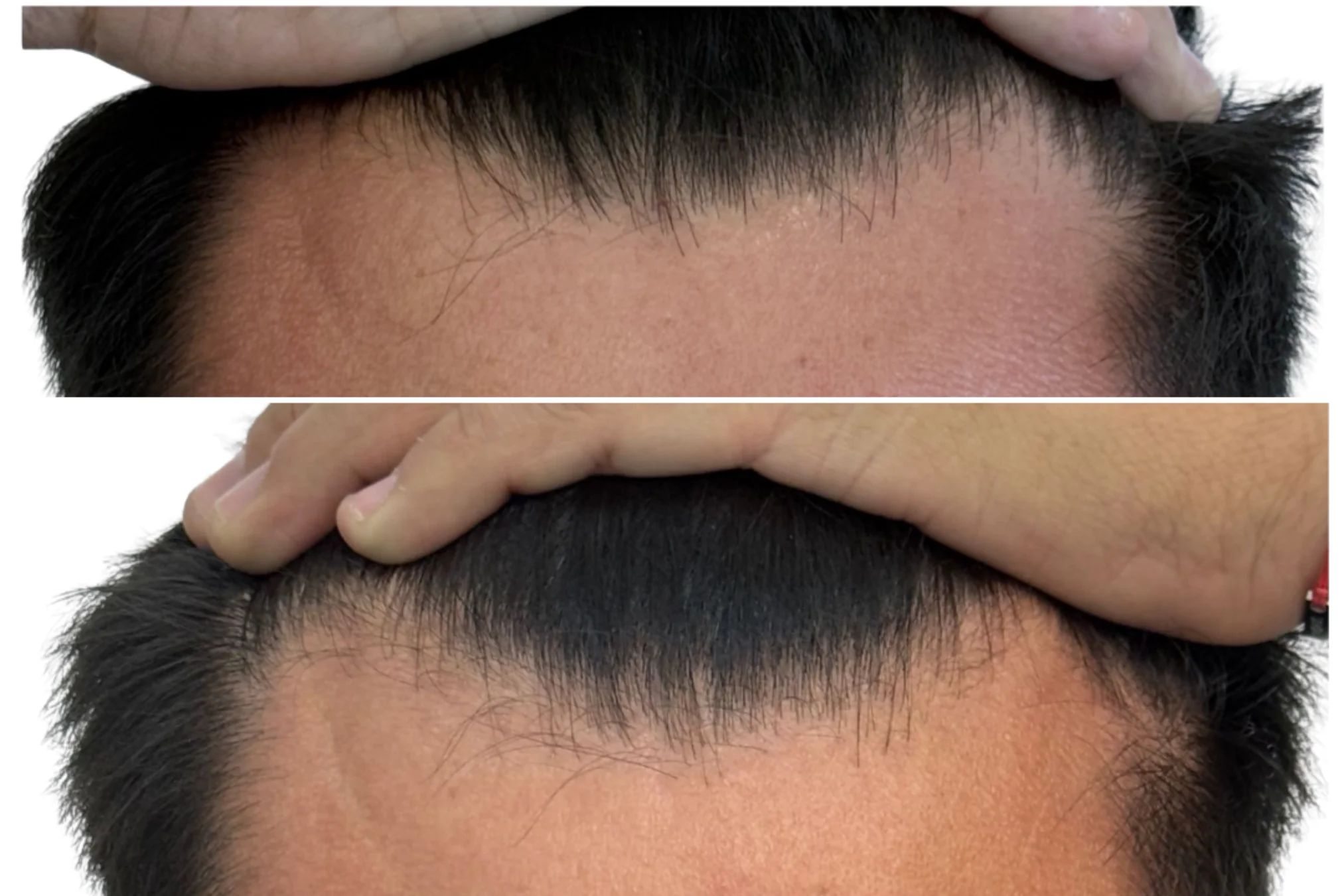 Resultados antes y después de Terapia Capilar Masculina en Avoria