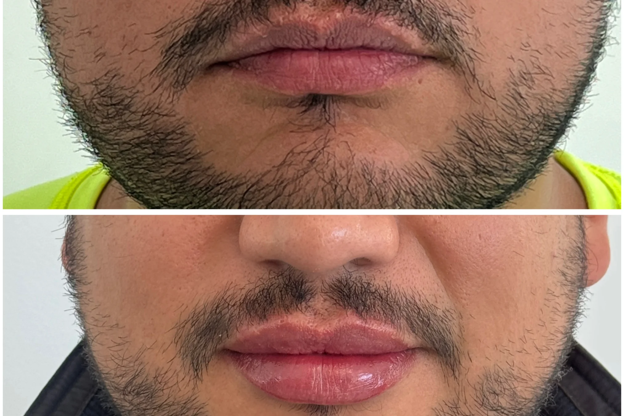 Resultados antes y después de Lip Filler para Él en Avoria