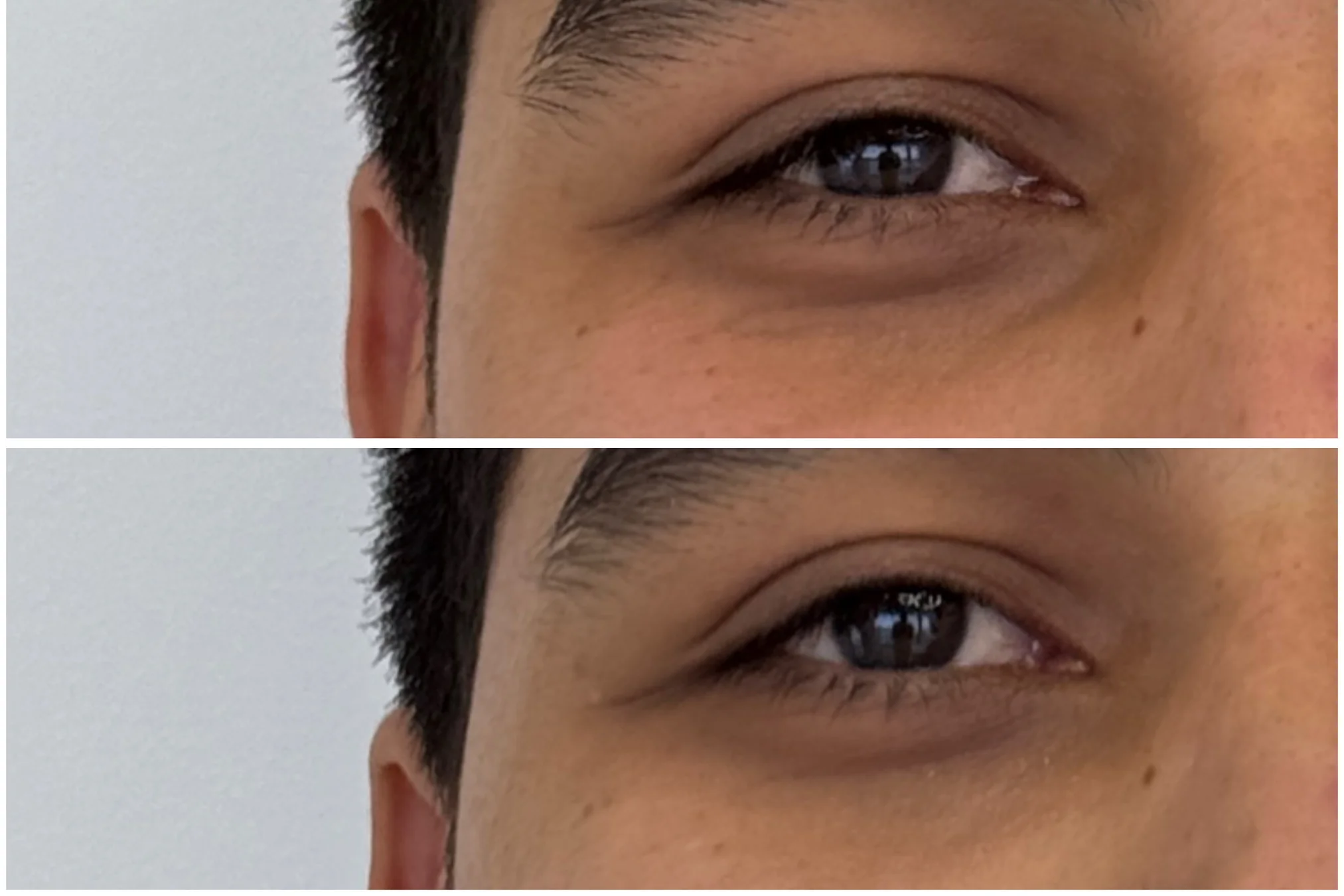 Resultados antes y después de Relleno de Ojeras en Avoria