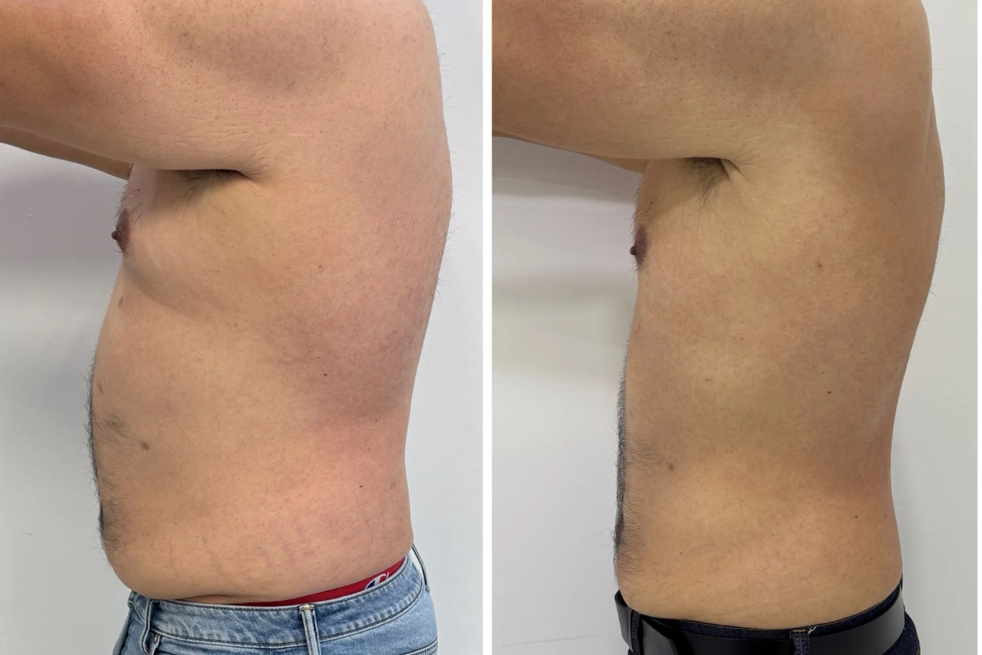 Resultados antes y después de Pérdida de Peso Médica en Avoria