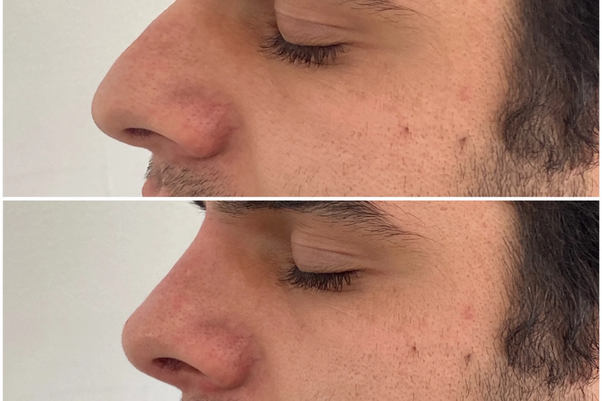 Resultados antes y después de Rinomodelación Masculina en Avoria