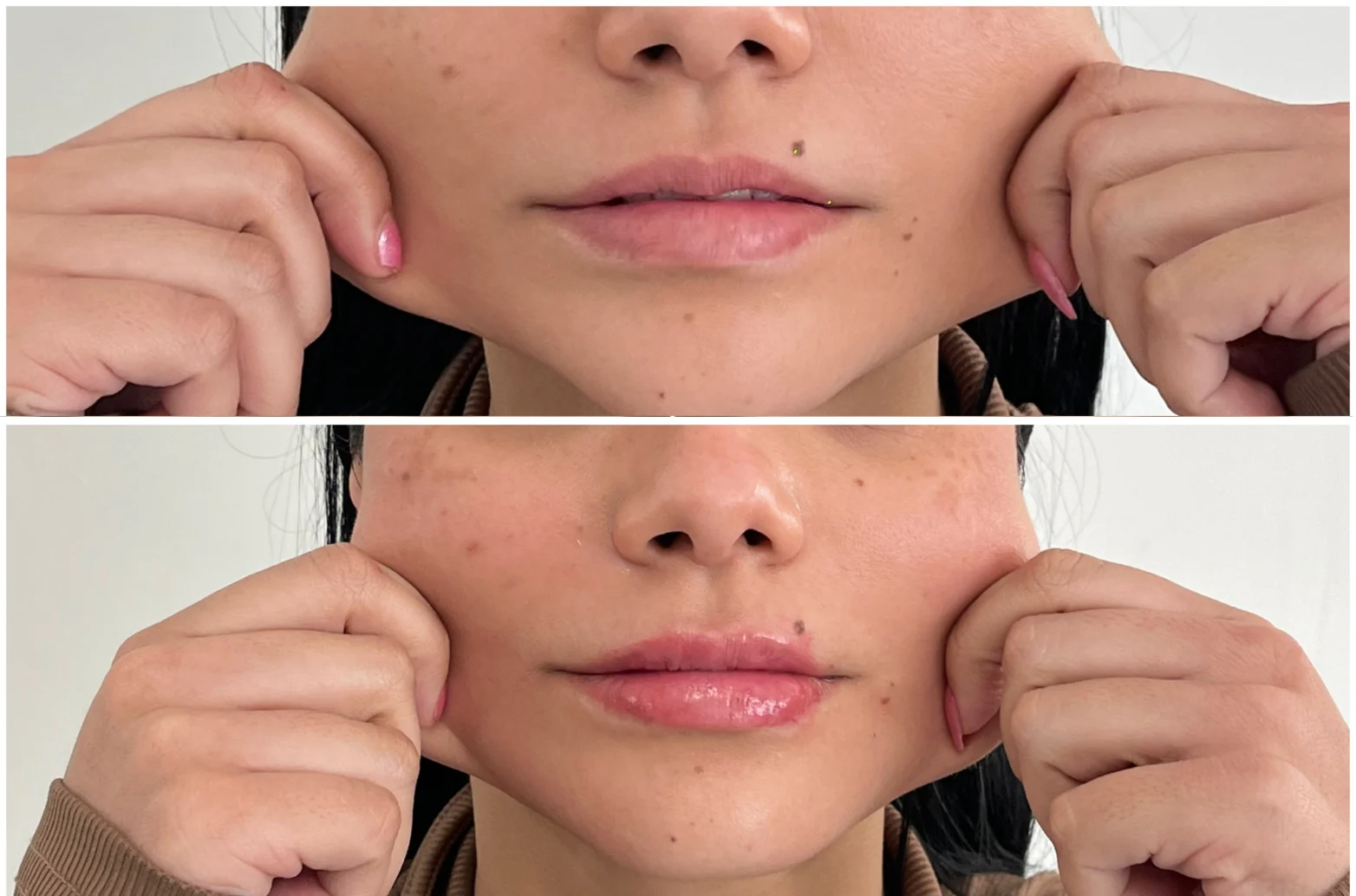 Resultados antes y después de Bioestimulación de Colágeno en Avoria