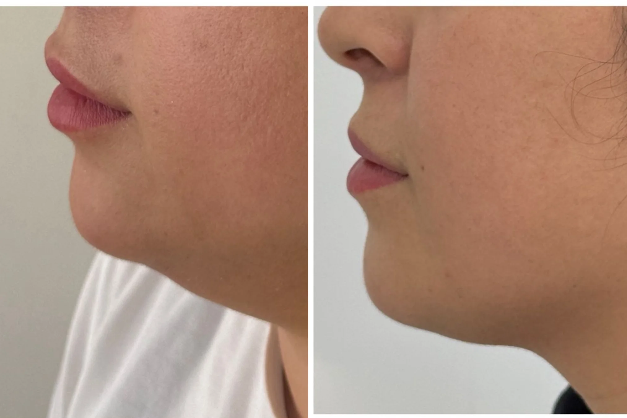 Resultados antes y después de Endolift (Lifting Láser) en Avoria