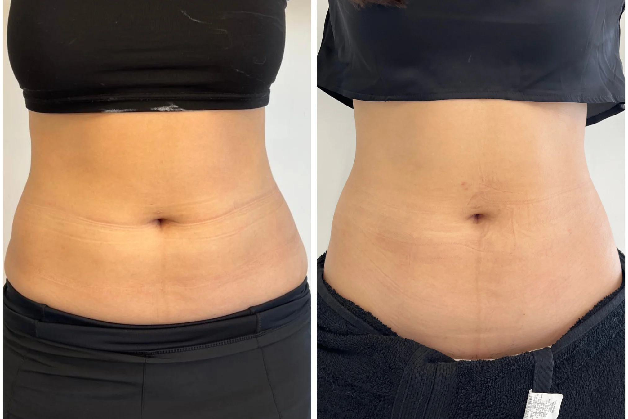 Resultados antes y después de Lipoenzimas PB Serum en Avoria