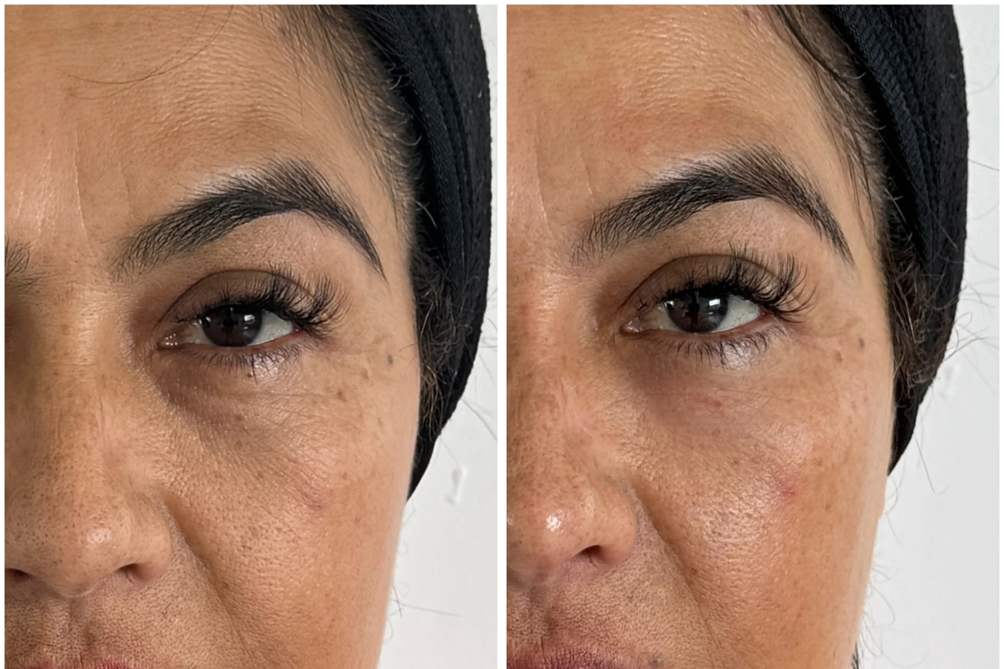 Resultados antes y después de Tratamiento de Ojeras en Avoria