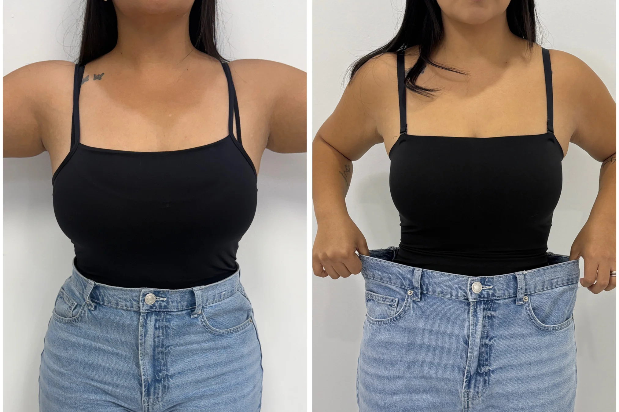 Resultados antes y después de Pérdida de Peso Médica en Avoria