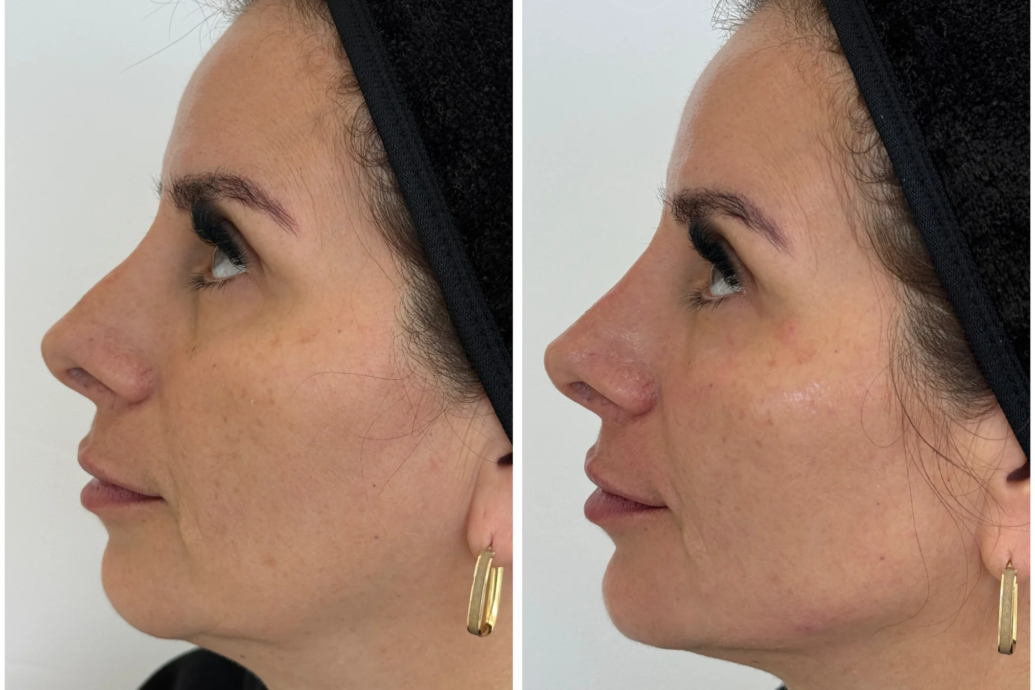Resultados antes y después de Rellenos Faciales (Full Face) en Avoria