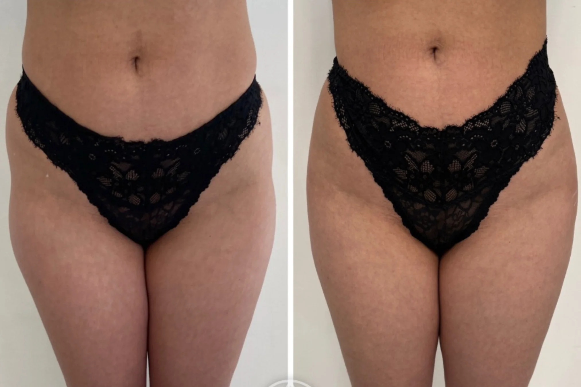 Resultados antes y después de Rellenos Corporales en Avoria