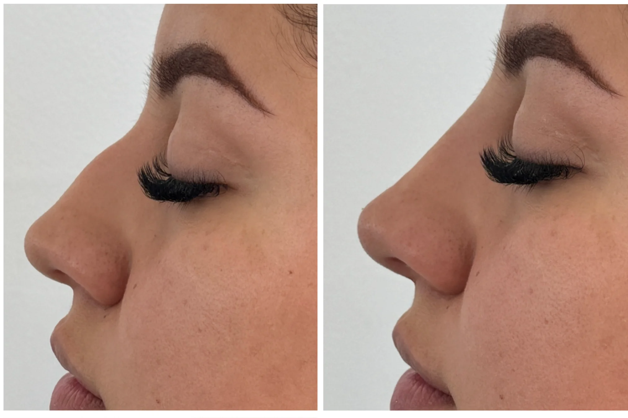 Resultados antes y después de Rinomodelación sin Cirugía en Avoria