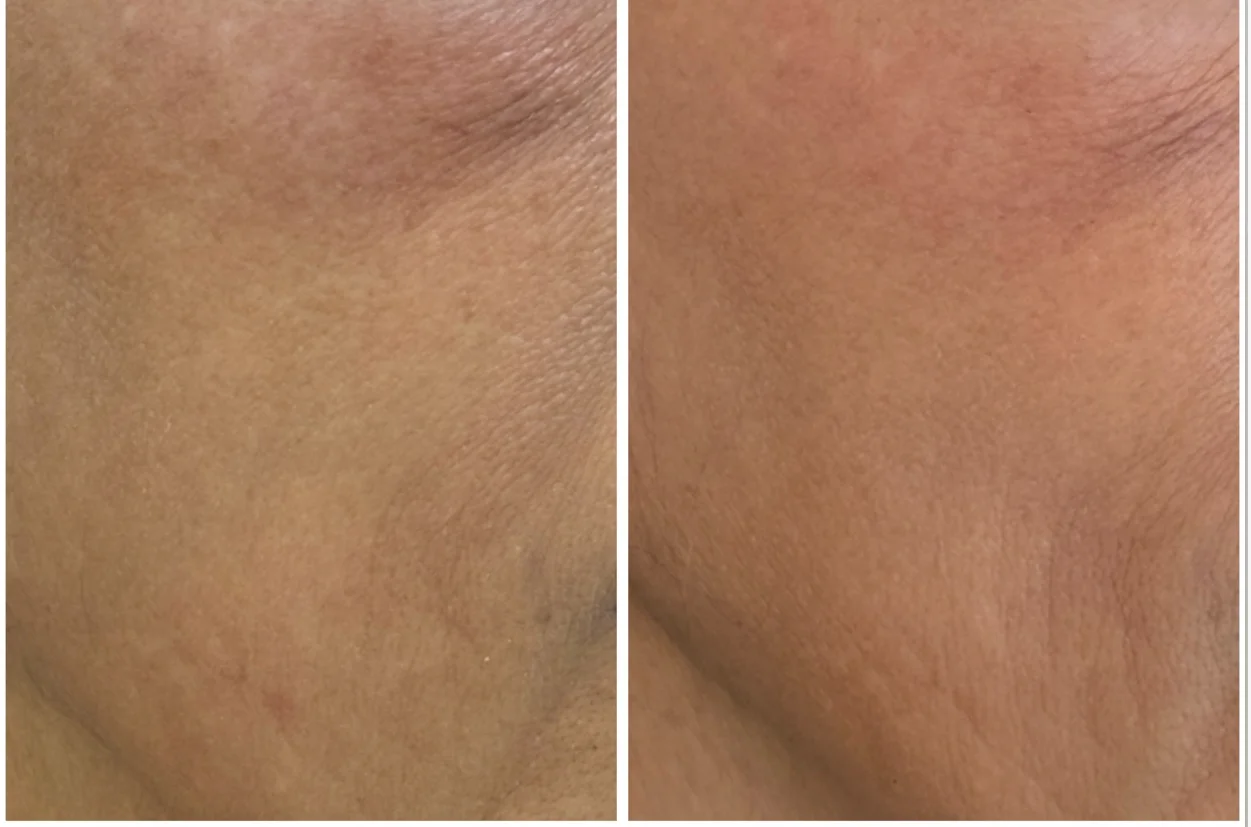 Resultados antes y después de Skinbooster (Hidratación Dérmica) en Avoria